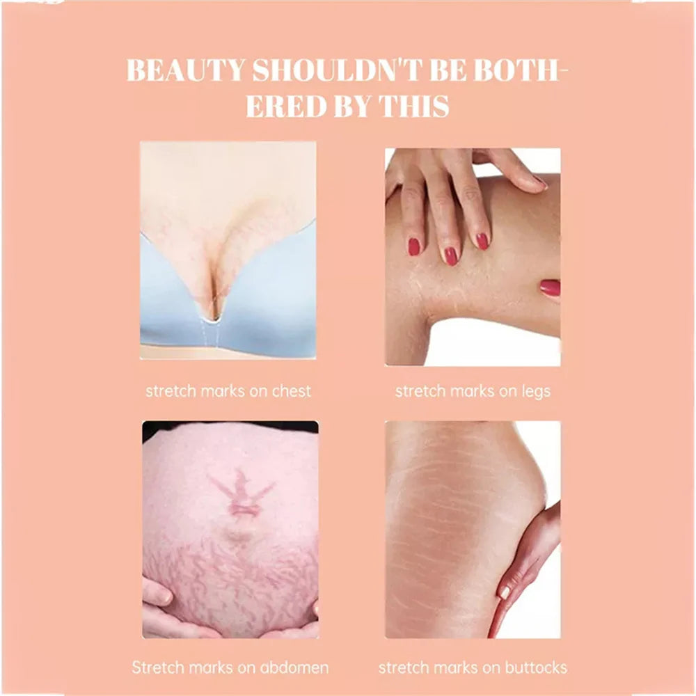 Stretch Marks Remover Oil