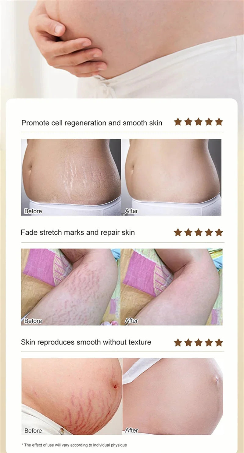 Maternity Scar Stretch Marks Cream