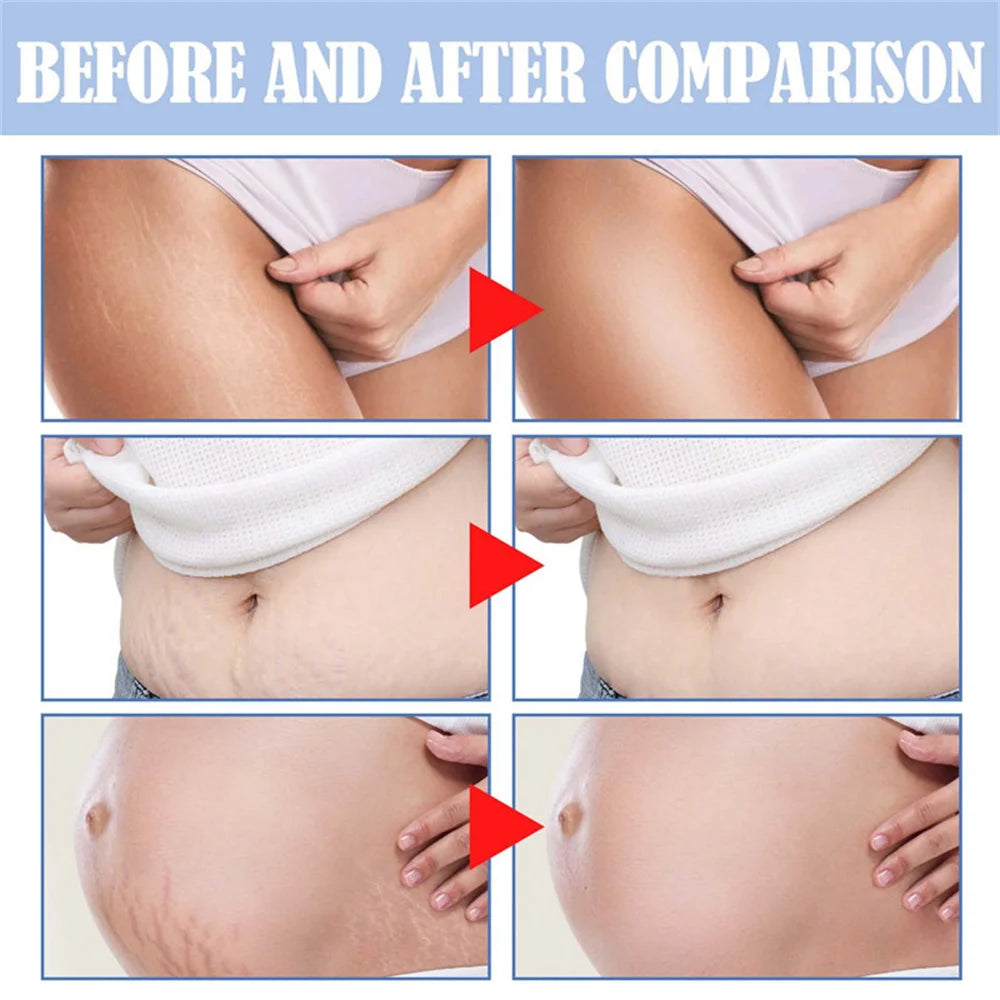 Stretch Marks Remover Oil