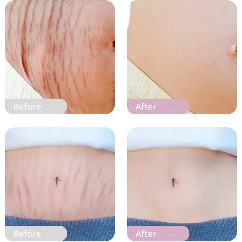 Stretch Marks Remover Oil