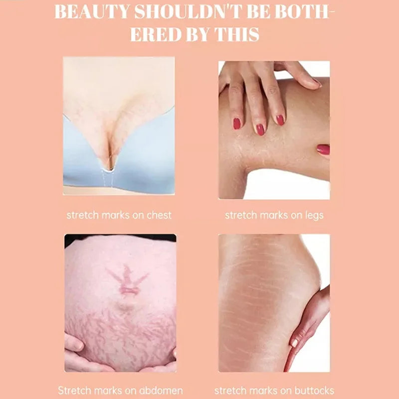 Stretch Marks Remover Oil