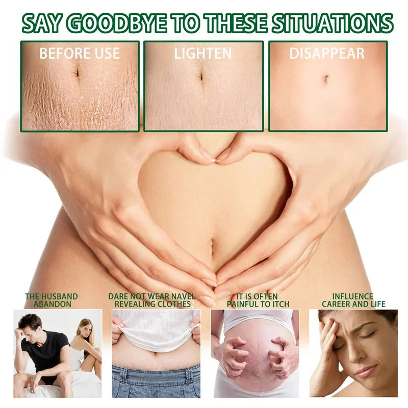 Maternity Scar Stretch Marks Cream
