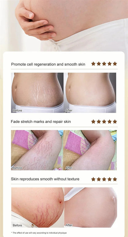 Maternity Scar Stretch Marks Cream