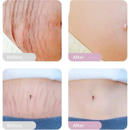 Stretch Marks Remover Oil